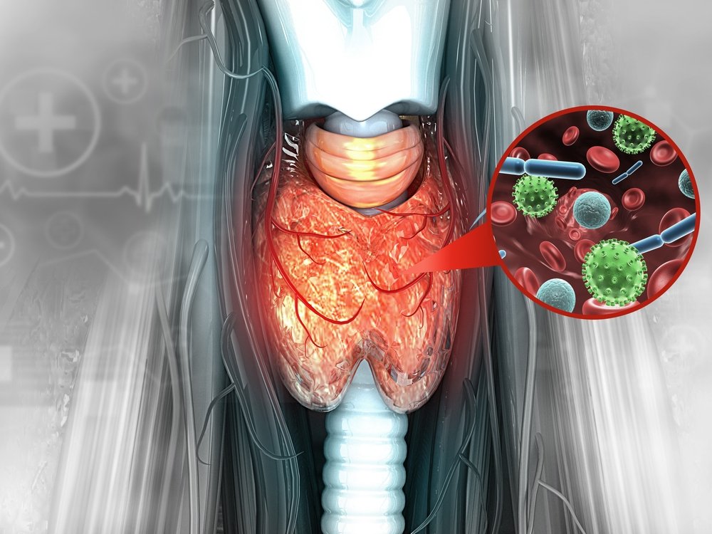 علاج تضخم الغدة الدرقية
